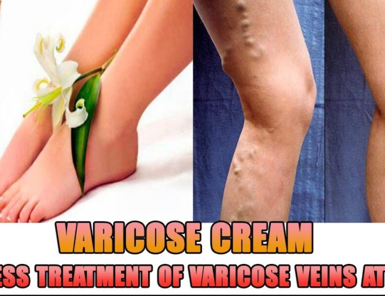 Varikosette Cream Philippines — Review, Price, Where to buy